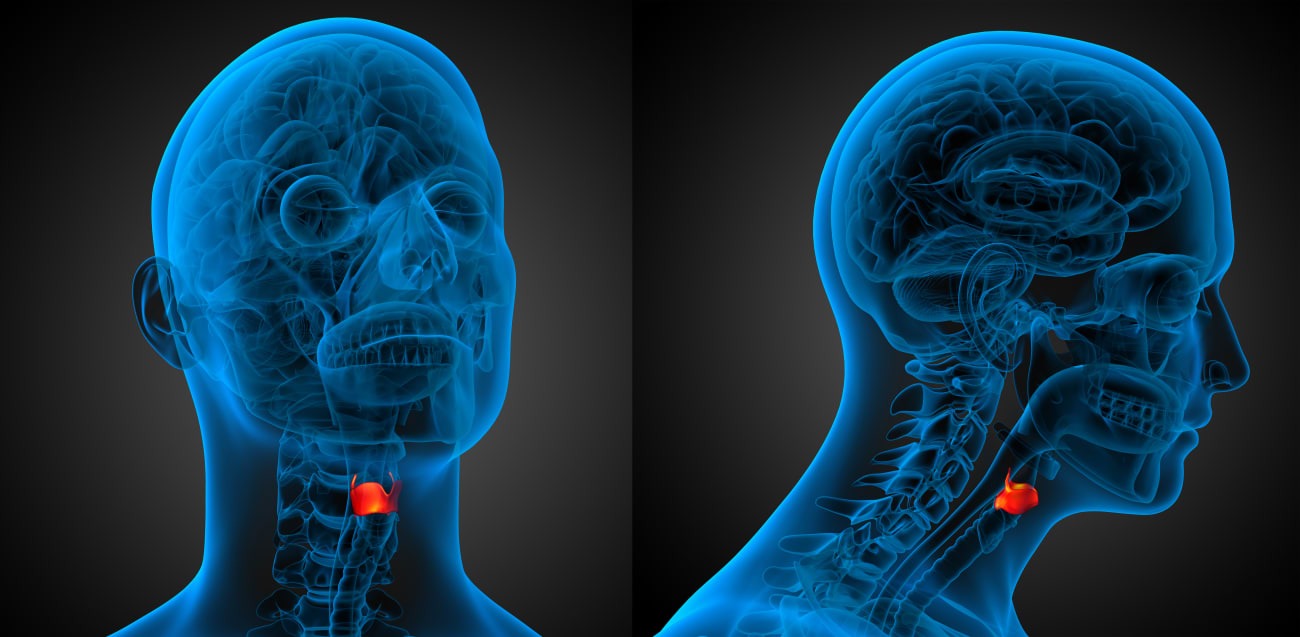 Laryngeal cancer